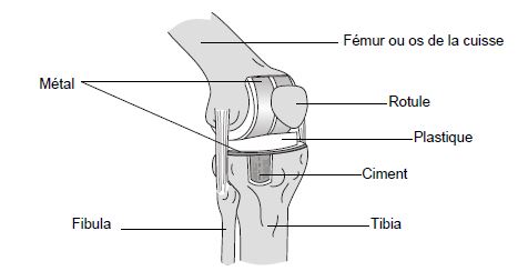 Arthroplastie genou : Remplacement du genou
