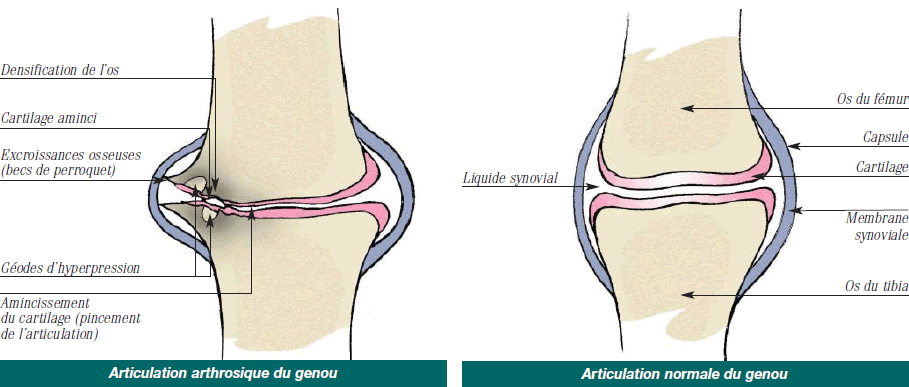Arthrose du genou
