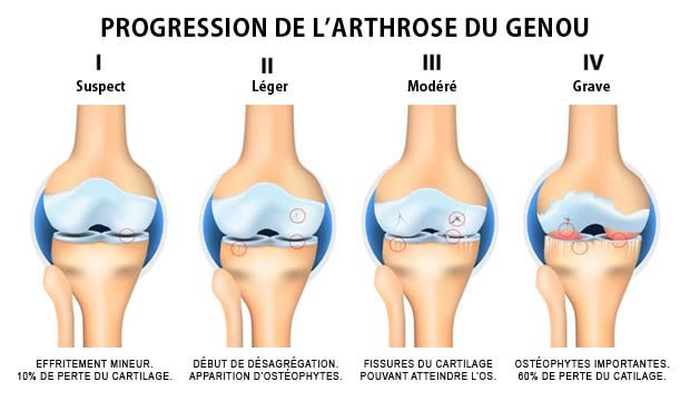 Gonarthrose : Arthrose du genou