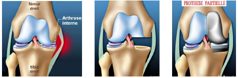 Chirurgie du genou : Prothèse genou partielle