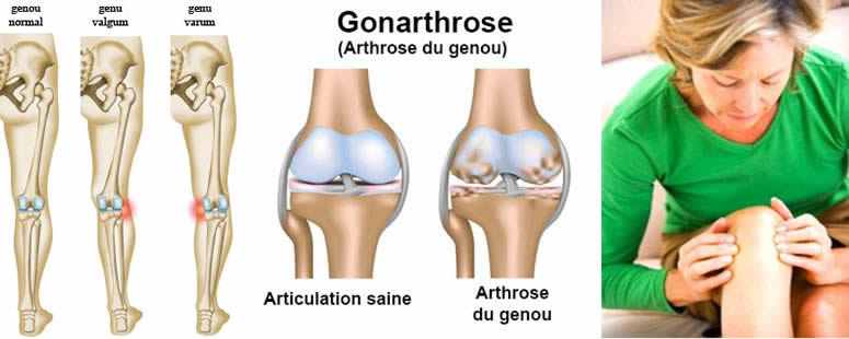 Arthrose du genou : Traitement du genou