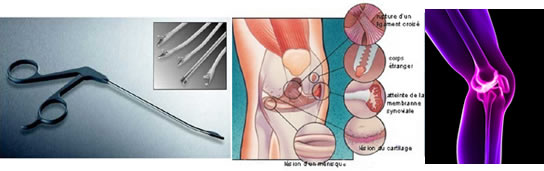 Arthroscopie du genou