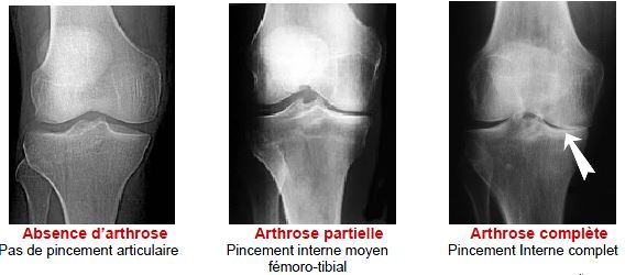 Arthrose de genou