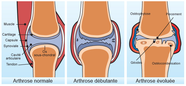 Arthrose du genou chronique