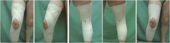 Bandage genou : douleur au genou