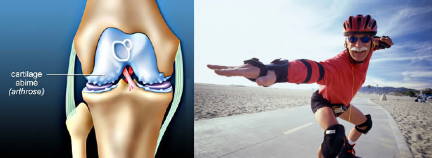 Arthrose du genou : Cartilage du genou