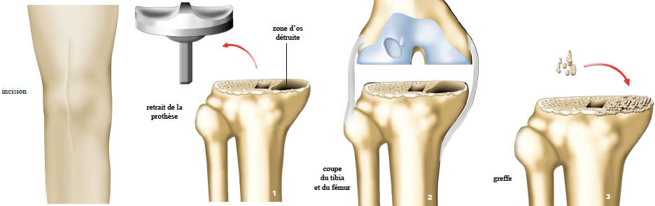 Chirurgie prothèse du genou