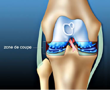 Chirurgie arthrose du genou