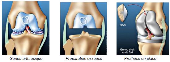 Chirurgie du genou : Prothèse genou
