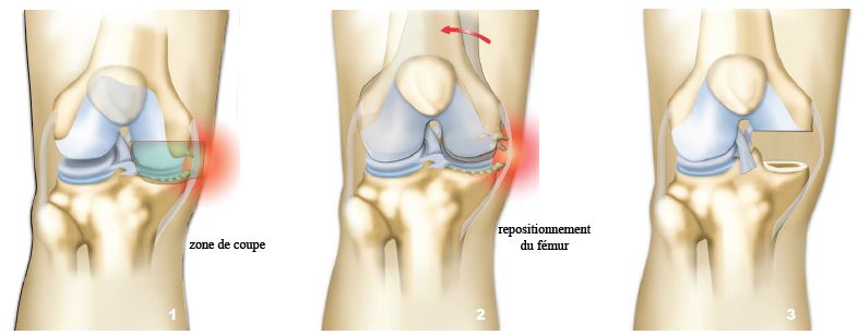 Chirurgie arthrose du genou