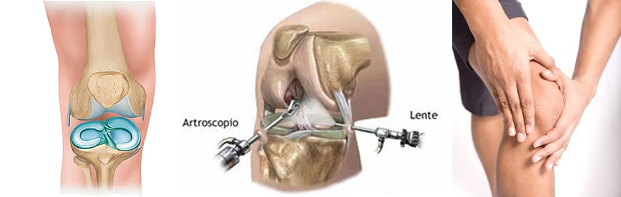 Chirurgie ménisque genou : Douleur genou