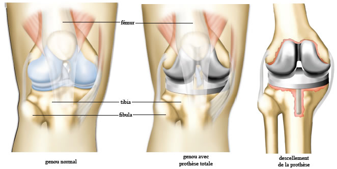 Chirurgie prothèse du genou