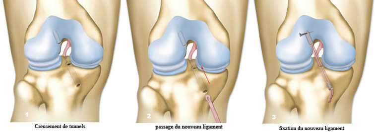 Déchirure des ligaments du genou