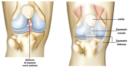Déchirure des ligaments du genou