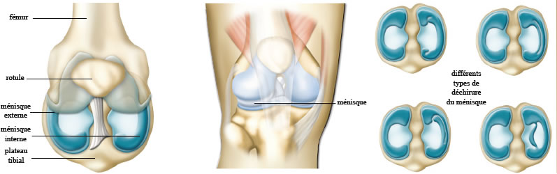 Déchirure des ménisques du genou