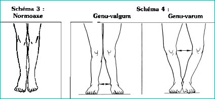 Douleur de genou