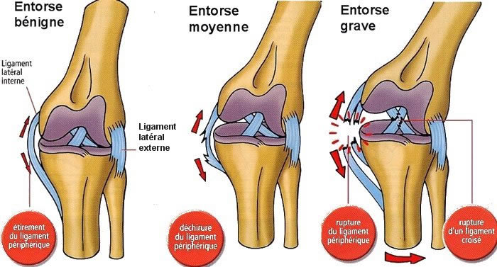 Entorse du genou : Traumatismes au ski | Douleur genou