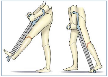 Exercices de l'arthrose du genou