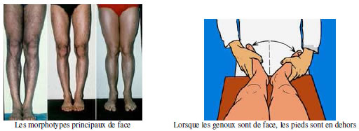 Genou douloureux : Diagnostic douleur