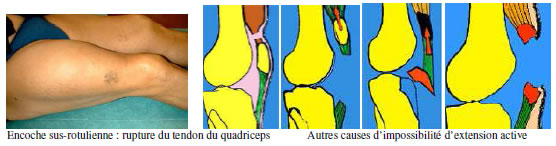 Genou douloureux : Diagnostic douleur