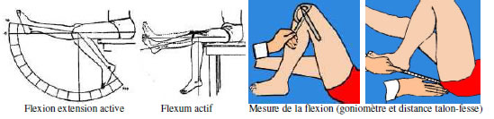 Genou douloureux : Diagnostic douleur