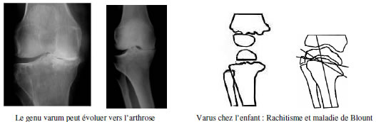 Genou douloureux : Diagnostic douleur