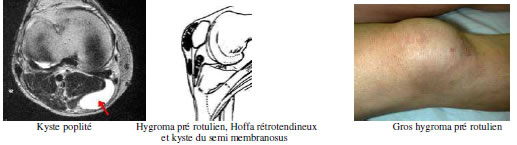 Genou douloureux : Diagnostic douleur