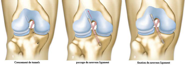 Ligamentoplastie du genou