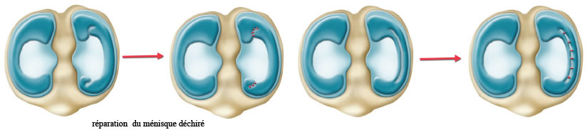 Déchirure des ménisques du genou