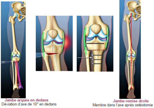 Ostéotomie du genou