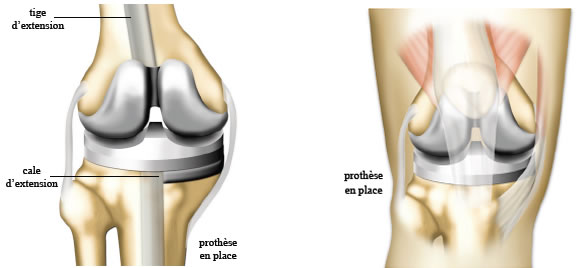 Prothèse genou : Douleur genou