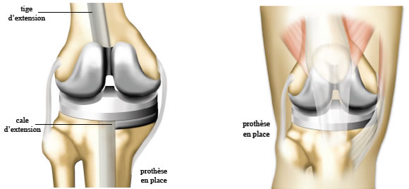 Prothèse du genou