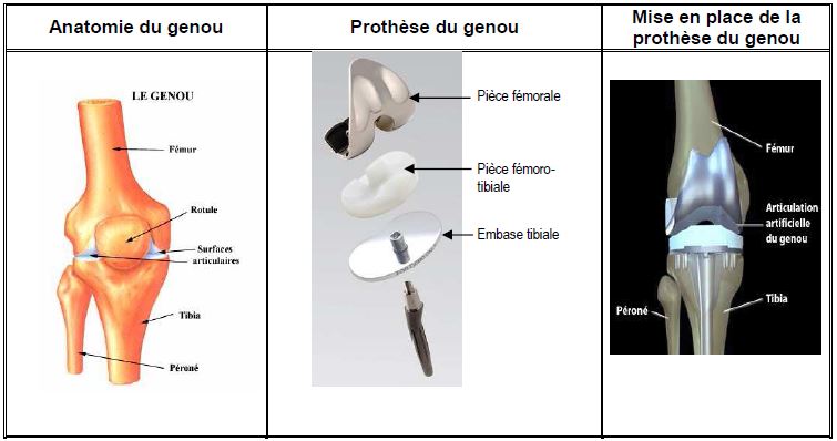 Prothèse totale du genou