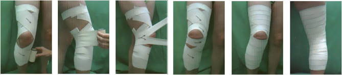 Bandage genou : douleur au genou Bandage genou : douleur au genou