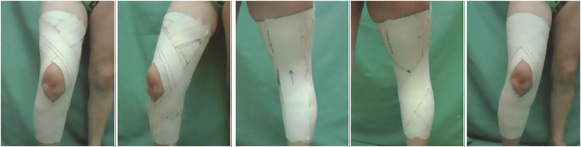 Bandage genou : douleur au genou Bandage genou : douleur au genou