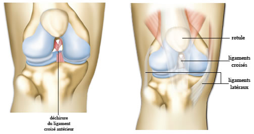 Déchirure des ligaments du genou Déchirure des ligaments du genou