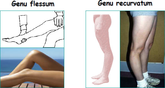 Douleur de genou Douleur de genou
