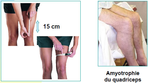 Douleur de genou Douleur de genou