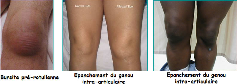 Douleur de genou Douleur de genou