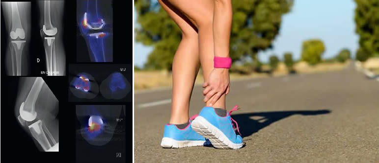 Déchirure des ligaments du genou : Radiographie Déchirure des ligaments du genou : Radiographie