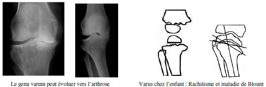 Genou douloureux : Diagnostic douleur Genou douloureux : Diagnostic douleur