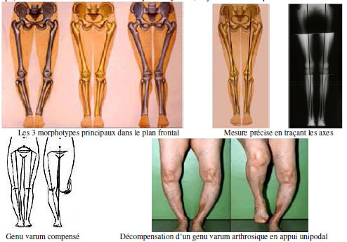 Genou douloureux : Diagnostic douleur Genou douloureux : Diagnostic douleur