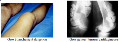 Genou douloureux : Diagnostic douleur