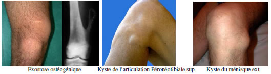 Genou douloureux : Diagnostic douleur Genou douloureux : Diagnostic douleur