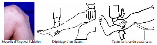 Genou douloureux : Diagnostic douleur Genou douloureux : Diagnostic douleur